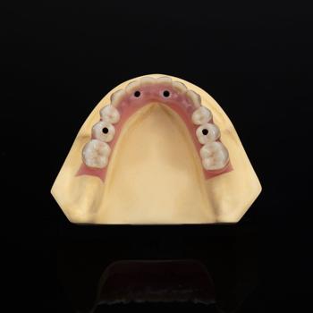 Dental Implant Restoration Titanium Abutment Denta
