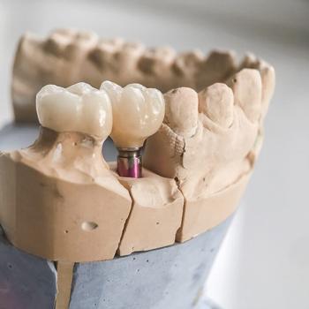Dental Implant Restoration Titanium Abutment Denta
