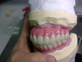 Dental Implant Restoration Tit